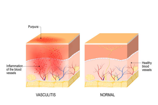 Vasculitis. Cross section of the human skin with vasculitis Vasculitis is damange of blood vessels by inflammation. Cross section of the human skin with vasculitis, and part of skin with healthy blood vesselss skin inflammation stock illustrations