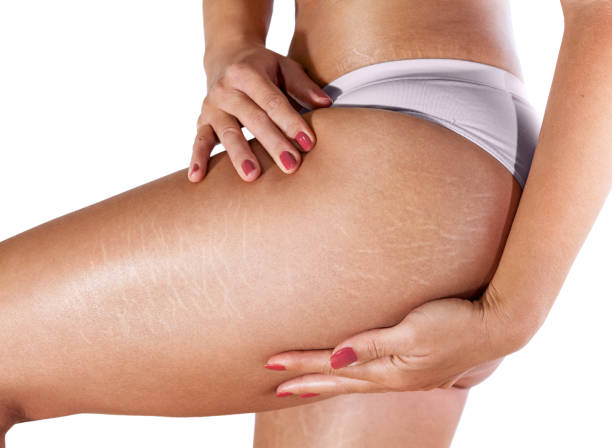 Stretch marks on woman's legs Stretch marks on woman's thighs and buttocks cellulite stock pictures, royalty-free photos & images