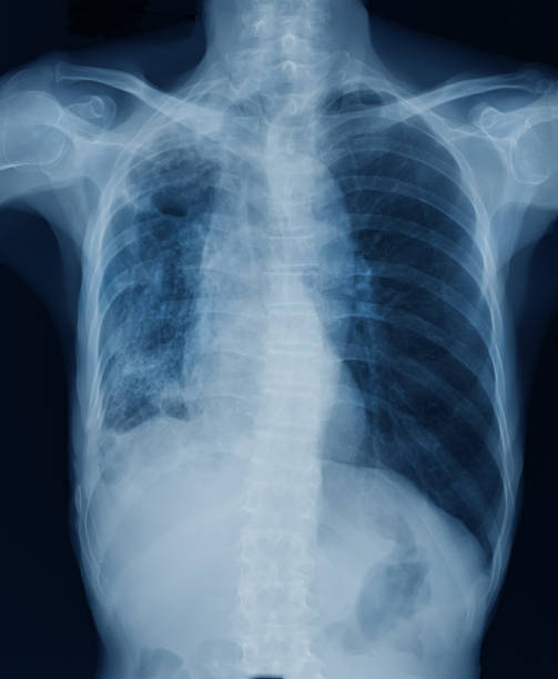 istock high quality chest x-ray image in blue tone 959639418