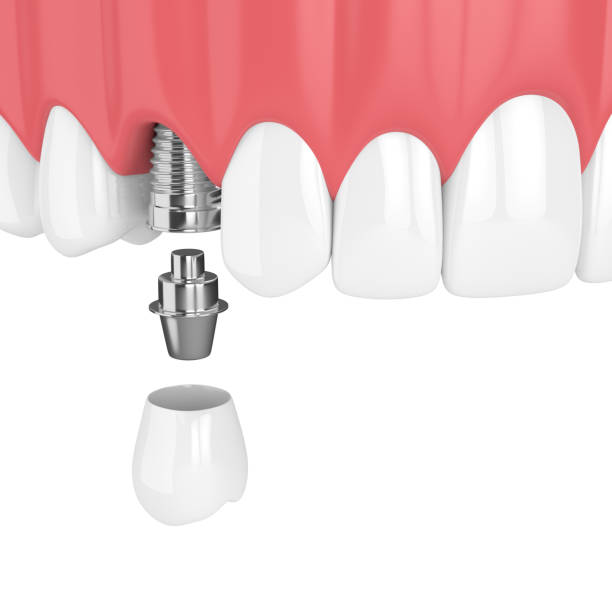 istock 3d render of upper jaw with dental premolar implant 959810926