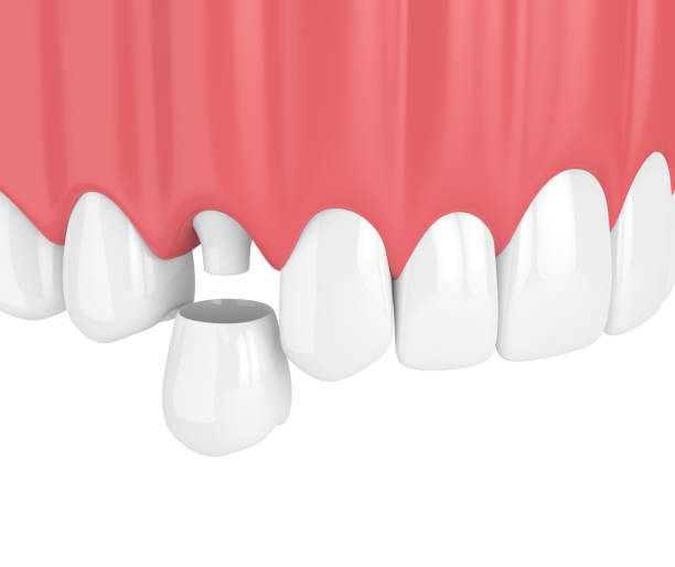 istock 3d render of upper jaw with dental premolar crown 959811286