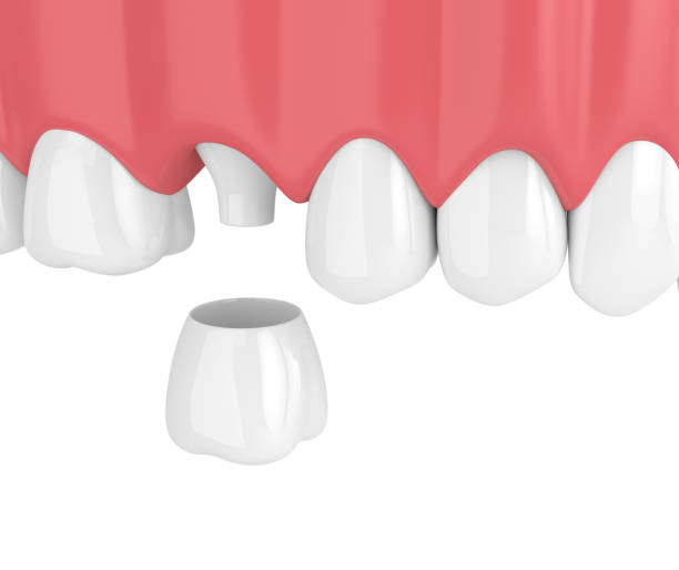 istock 3d render of upper jaw with dental crown restoration 959814948