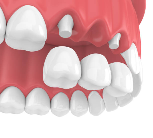 istock 3d render of dental bridge with crowns in upper jaw 959822852