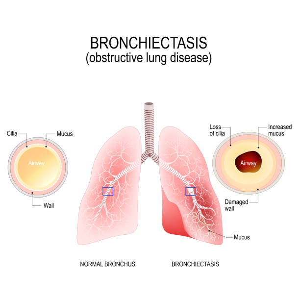 Normal bronchus and bronchiectasis. Bronchiectasis. Normal bronchus and bronchiectasis. enlarged small airways that collect mucus and cause recurrent lung infections. obstructive lung disease bronchitis stock illustrations