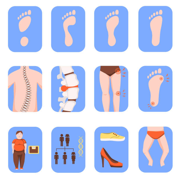 Flat feet icons vector illustration Fallen arches or flat foot icons set isolated on white background. Orthopedic disease, causes and symptoms. Health care concept. Color vector illustration high heel footprint stock illustrations