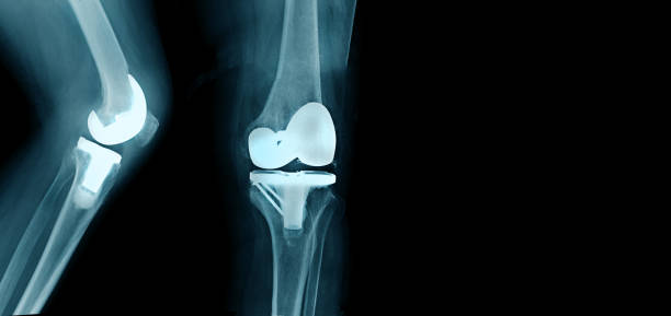 total knee replacement, website and printing use total knee replacement, website and printing use artificial knee photos stock pictures, royalty-free photos & images