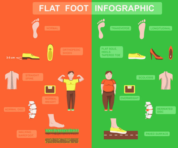 Flat foot vector infographic Flat foot and arch types infographic. Orthopedic disease, causes and symptoms. Health care and lifestyle concept. Color vector illustration high heel footprint stock illustrations