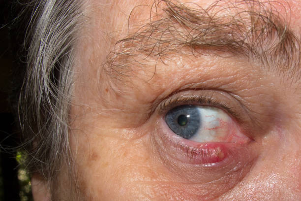 istock Senior woman with eye infection 960200310