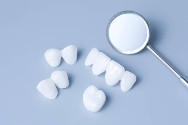istock Dental mirror and zircon dentures on a light blue background - Ceramic veneers - lumineers 960248236