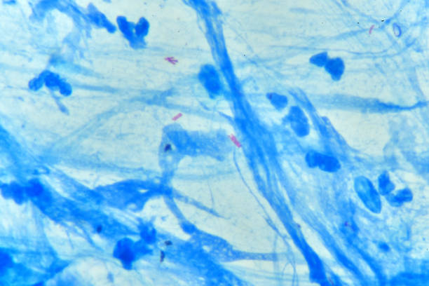 mycobacterium positiva en la tinción del esputo - tinción acidorresistente fotografías e imágenes de stock