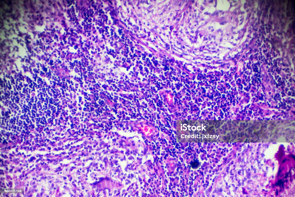 Lymph nodes tuberculosis pathological sample under microscope Tuberculosis Bacterium Stock Photo