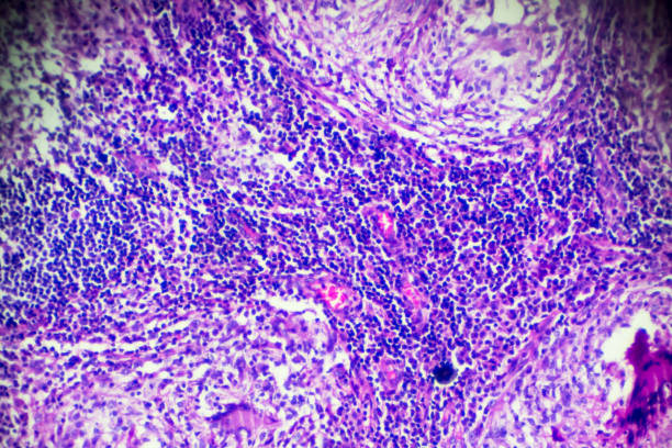 Lymph nodes tuberculosis pathological sample under microscope stock photo