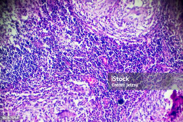 Lymph Nodes Tuberculosis Pathological Sample Under Microscope Stock Photo - Download Image Now