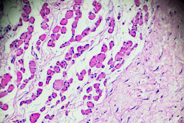 Atrophy of skeletal muscle human pathology sample under microscope stock photo