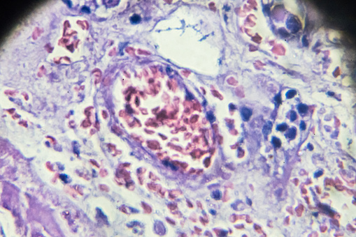 Caseation Caseous Necrosis Pathological Sample Under Microscopy Stock Photo ...
