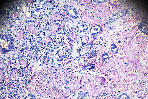 Caseation Caseous Necrosis Pathological Sample Under Microscopy Stock Photo ...