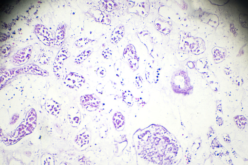 Caseation Caseous Necrosis Pathological Sample Under Microscopy Stock Photo ...