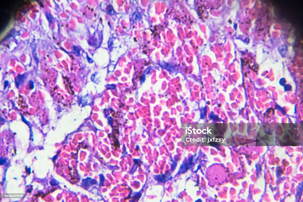 Thrombus human pathological sample under microscope Blood Clot Stock Photo