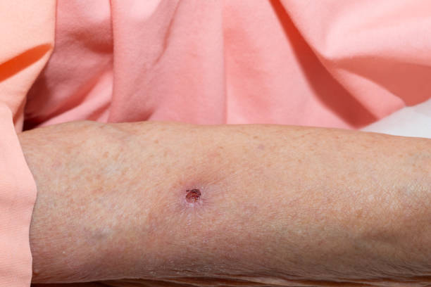 Scab. A wound form a scab on an arm of elderly patient. scab arm stock pictures, royalty-free photos & images