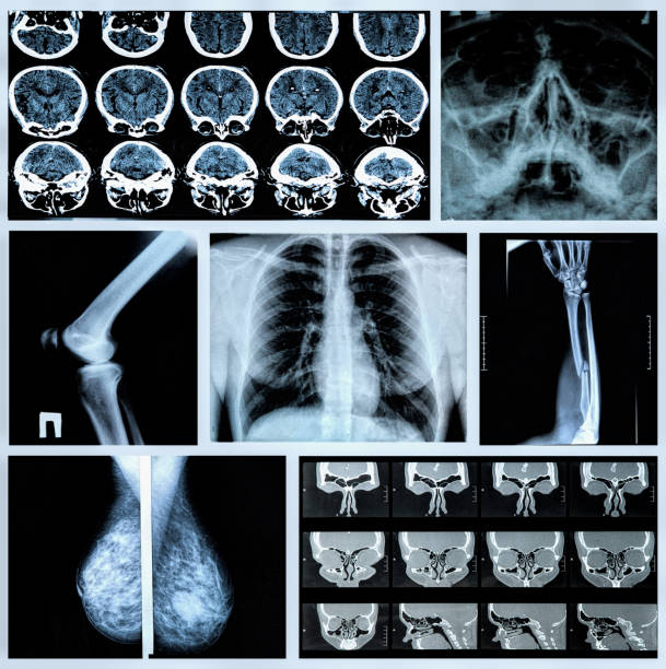 menschlicher knochen - mammogram mri scan breast breast examination stock-fotos und bilder