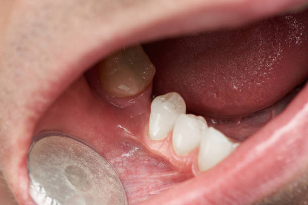 istock Tooth gap in man mouth 961017440