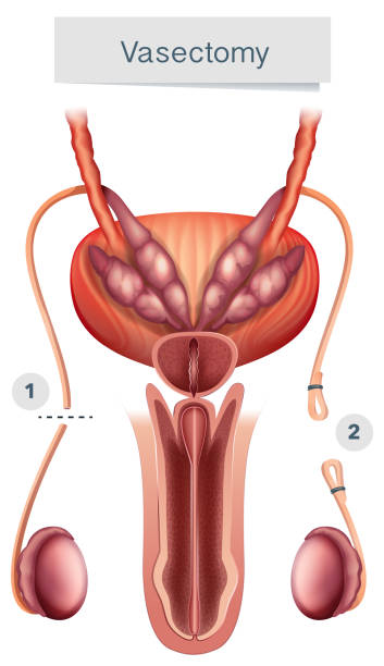 Human Anatomy Of Vasectomy On White Background Stock Illustration -  Download Image Now - Vasectomy, Art, Childbirth - iStock
