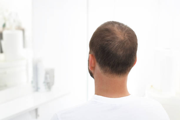 alopecia - 薄毛 ストックフォトと画像
