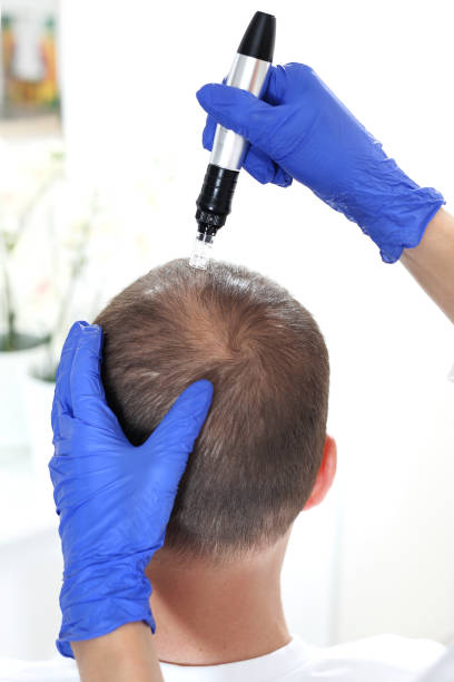 istock Needle mesotherapy of the scalp. 961317662