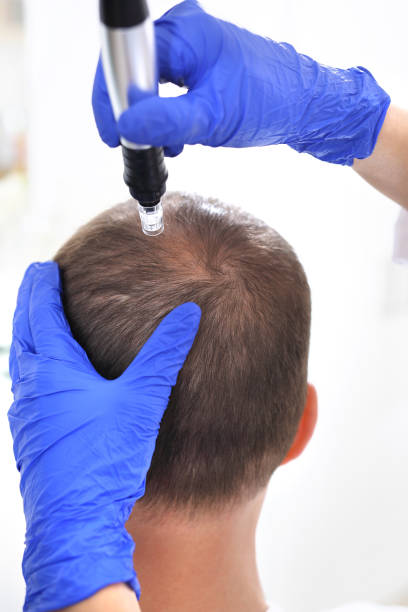 istock Microneedle mesotherapy of the scalp. 961317668