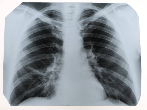 radiografia di un torace umano o polmoni radiografia colpo, tecnologia medica e concetto diagnostico clinica roentgen - human lung x ray image x ray human spine foto e immagini stock