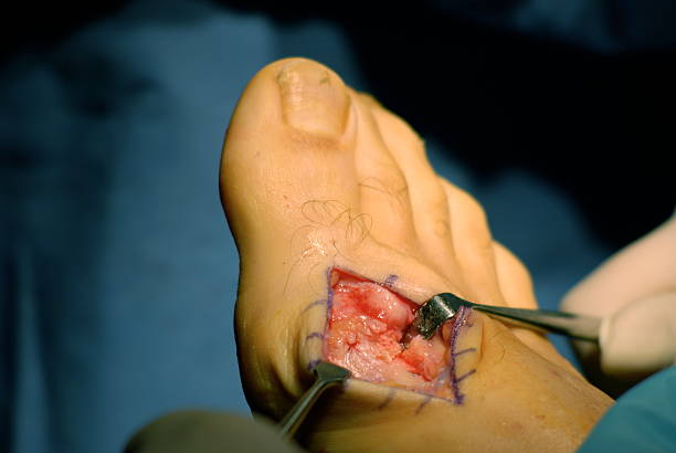 cirurgia bunionectomy incision para - podiatrist podiatry orthopedic surgeon human foot - fotografias e filmes do acervo