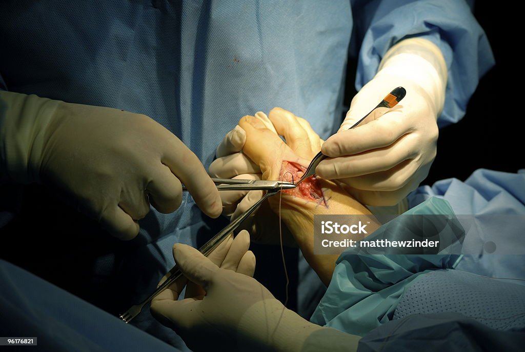 Zamykania rany chirurgicznej - Zbiór zdjęć royalty-free (Podiatra)