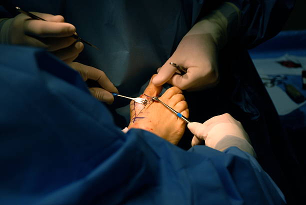 fasi iniziali della chirurgia alluce valgo - podiatry human foot podiatrist surgery foto e immagini stock
