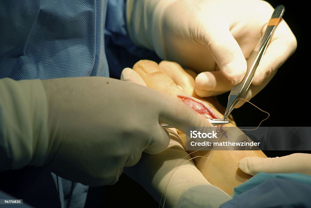 Cierre de la herida quirúrgica - Foto de stock de Cirugía libre de derechos