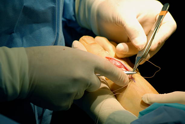 fechamento encerramento cirúrgica - podiatrist podiatry orthopedic surgeon human foot - fotografias e filmes do acervo