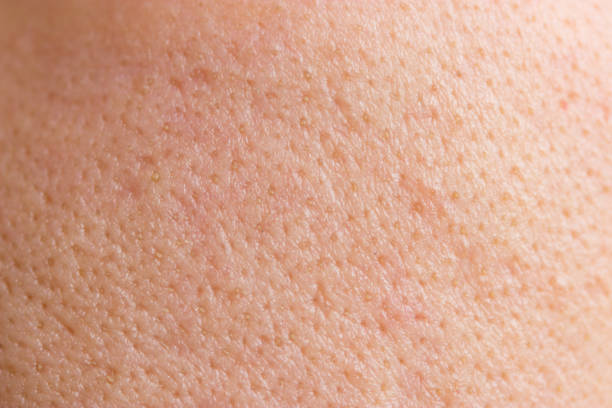 istock Acne skin on face woman,problem skin 961805430