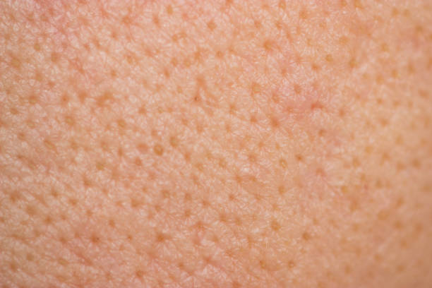 istock Acne skin on face woman,problem skin 961805444