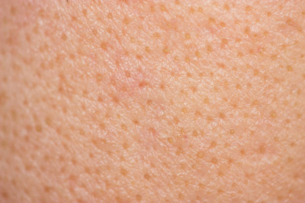 istock Acne skin on face woman,problem skin 961805452