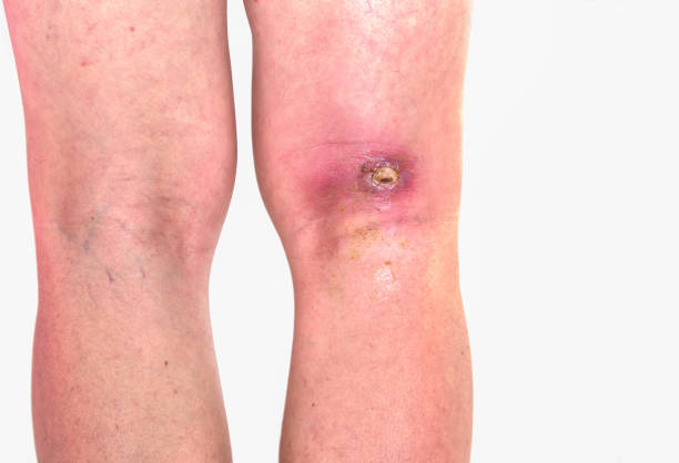 abcess popiteal area, inflammation of popiteal zone at right leg, infected wound righ knee bent stock photo