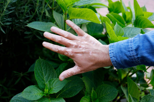 istock Close-up of hands with vitiligo depigmentation 961973488