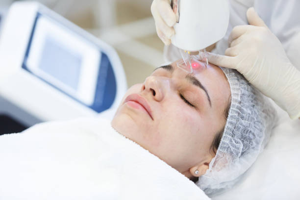 istock Professional beautician making facial peeling in a forehead. Laser face peeling. 962090920