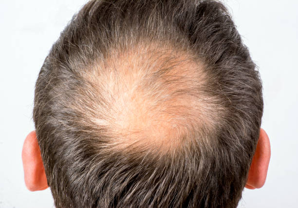 Bald man close-up on white ground Close-up bald man on white ground. Dandruff and baldness problem. falling behind stock pictures, royalty-free photos & images