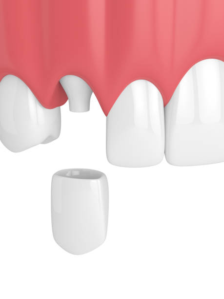istock 3d render of upper jaw with dental canine crown 962447340