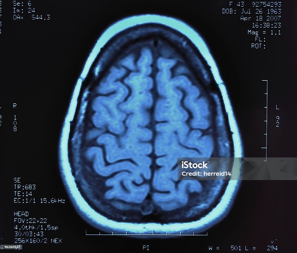 MRI del cerebro - Foto de stock de Asistencia sanitaria y medicina libre de derechos