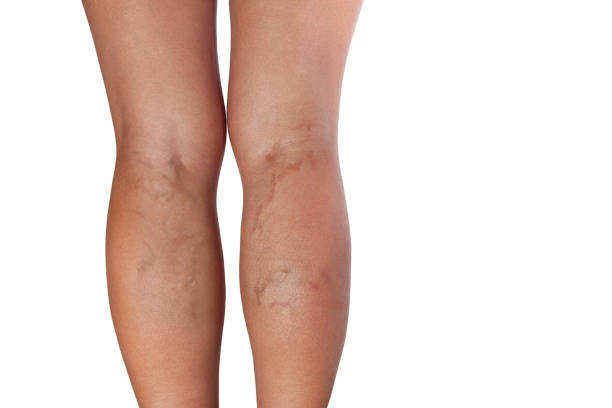 Varicose veins of woman legs Varicose veins on woman legs varicose vein stock pictures, royalty-free photos & images