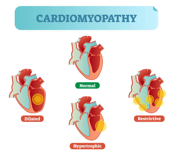 Cardiomyopathy medical disorders cross section diagram, vector illustration examples with normal, dilated, hypertrophic and restrictive conditions. Cardiomyopathy - human heart medical disorders cross section diagram, vector illustration examples with normal, dilated, hypertrophic and restrictive conditions. Heart muscle diseases. dilation stock illustrations