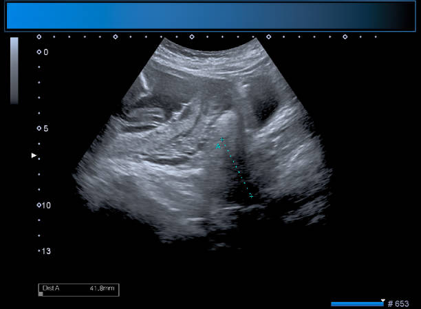 istock Identical twin boy obstetrical ultrasound 963176250