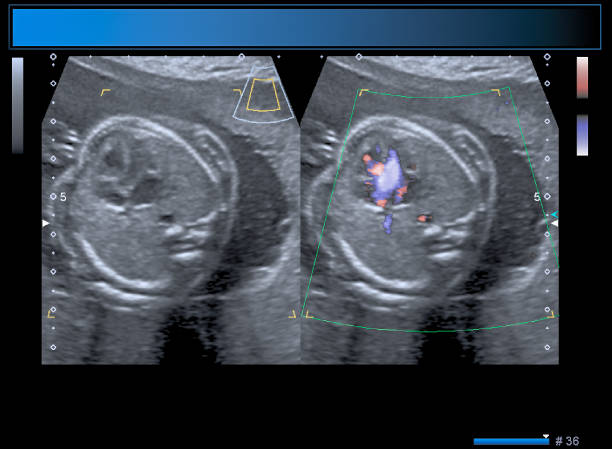 istock Identical twin boy obstetrical ultrasound 963176360