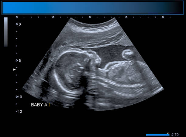 Identical twin boy obstetrical ultrasound stock photo