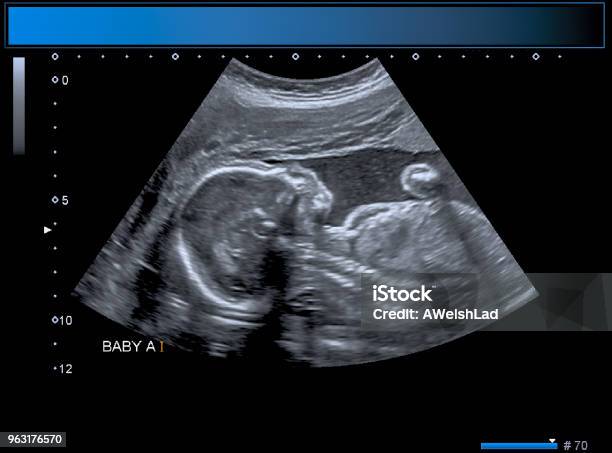 Identical Twin Boy Obstetrical Ultrasound Stock Photo - Download Image Now - Ultrasound, Baby - Human Age, Uterus